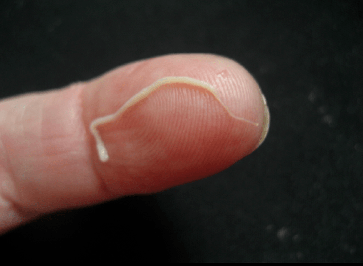 الديدان الخيطية من جسم الإنسان